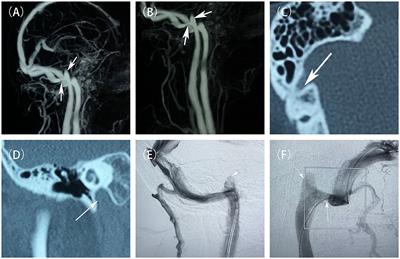 Cerebral venous sinus stenting and jugular bulb embolization for pulsatile tinnitus: A case report